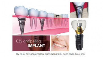 dia-chi-trong-rang-implant-tot-nhat-tinh-dak-nong