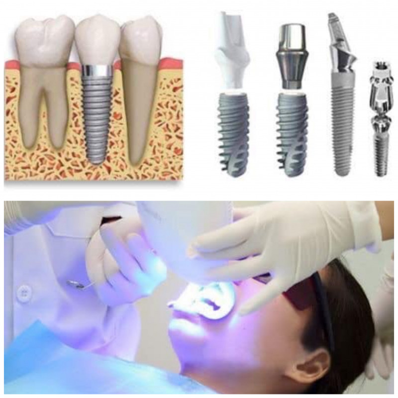 Phương pháp trồng răng Implant tại Nha Khoa Seoul