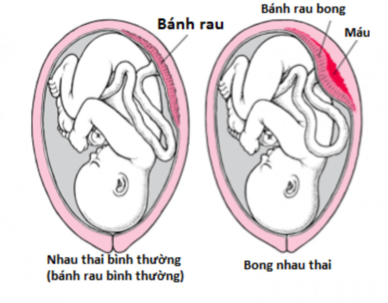 Nhau bong non