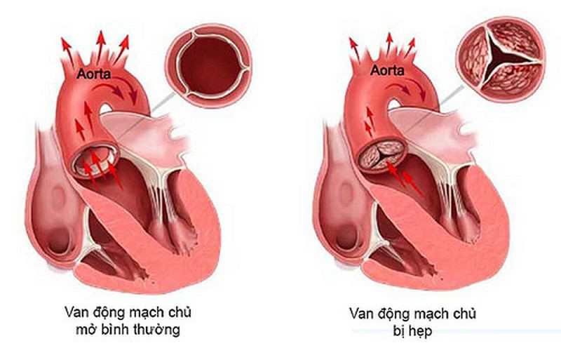 Bệnh van tim