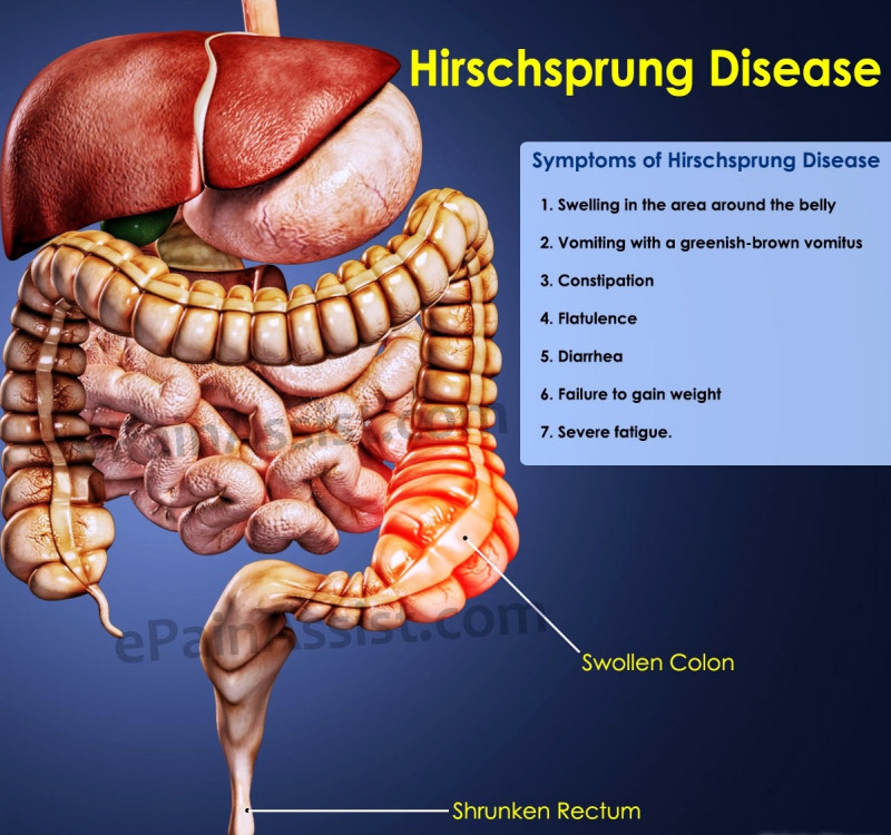 Bệnh phình đại tràng bẩm sinh (Hirschsprung)