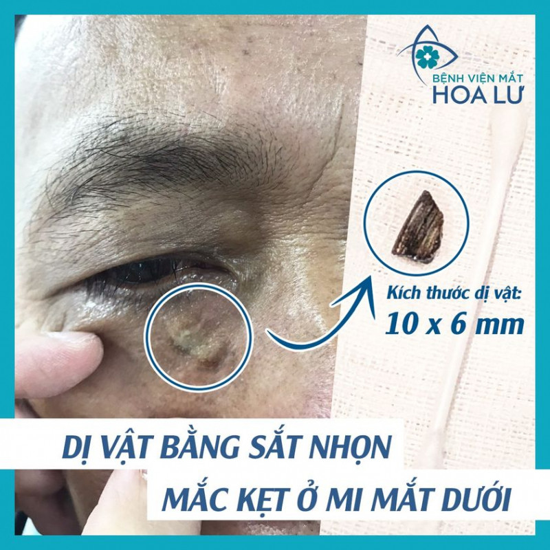 Bệnh viện Mắt Hoa Lư