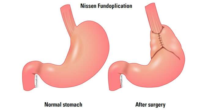 Phẫu thuật Nissen để thắt chặt cơ và ngăn ngừa trào ngược