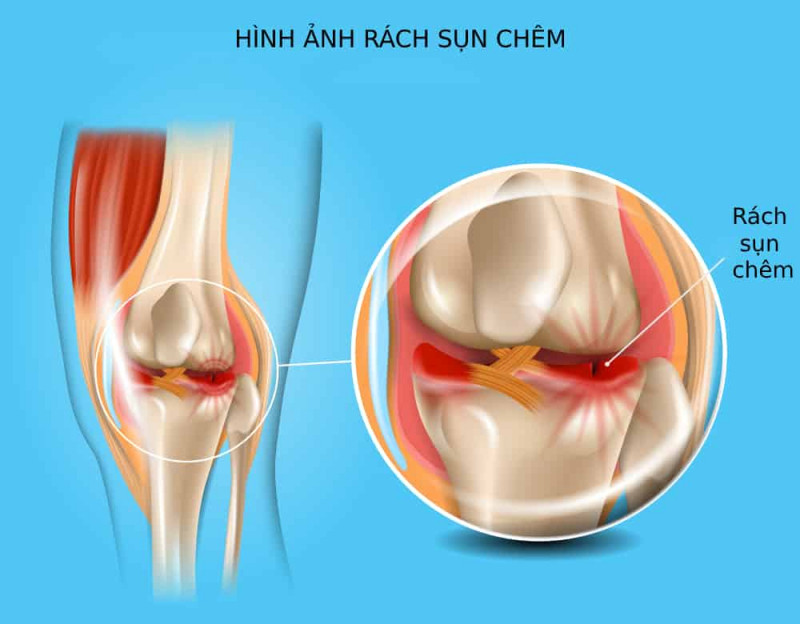 Rách sụn chêm