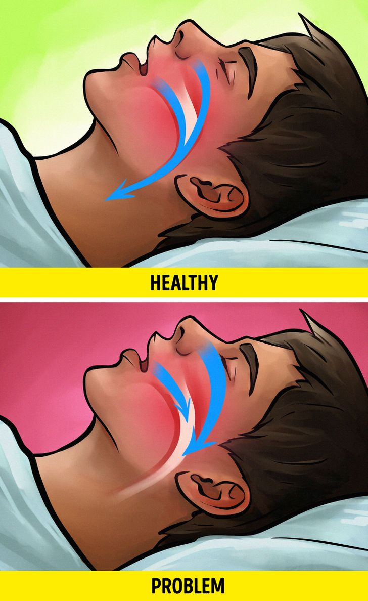 Bạn có thể mắc chứng ngưng thở khi ngủ (Obstructive Sleep Apnea – OSA)