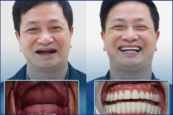 KH Chu Văn Bảy: Mất răng toàn hàm - Trồng răng implant All - on 6 bằng công nghệ Safe Tech