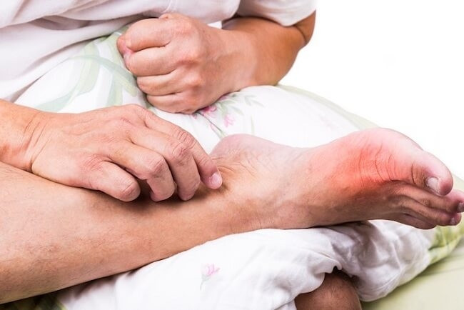 Nguyên nhân dẫn đến bệnh Gout