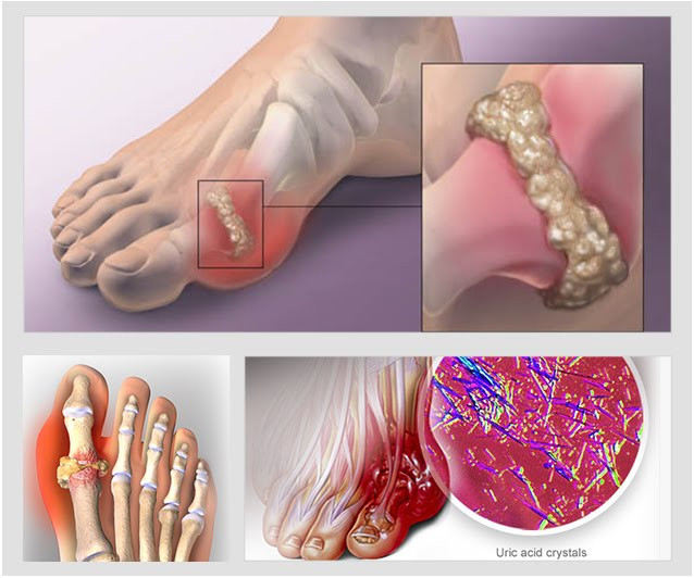 Cách chẩn đoán Gout