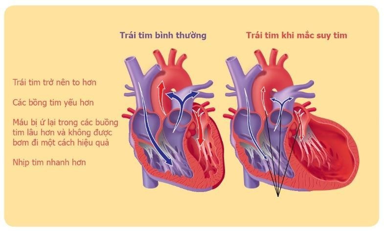 Những ai có nguy cơ mắc bệnh tim mạch?