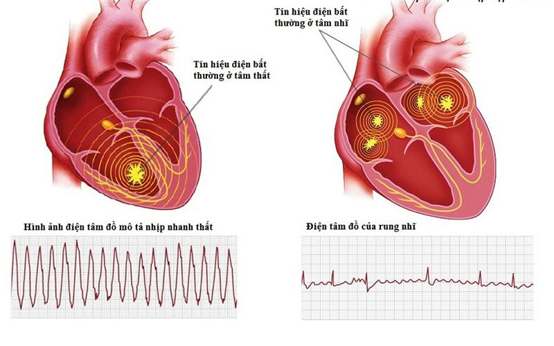 Những phương pháp điều trị bệnh tim mạch