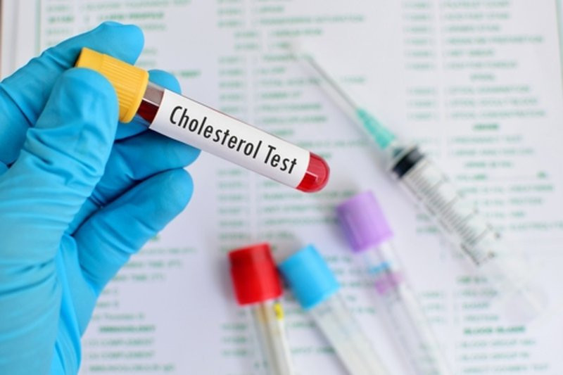 Kết quả xét nghiệm cholesterol và triglycerid thường có trong vòng 24 giờ
