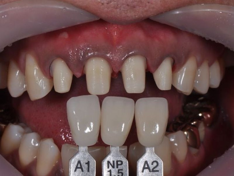 Hình ảnh mài và bọc 4 răng cửa hàm trên