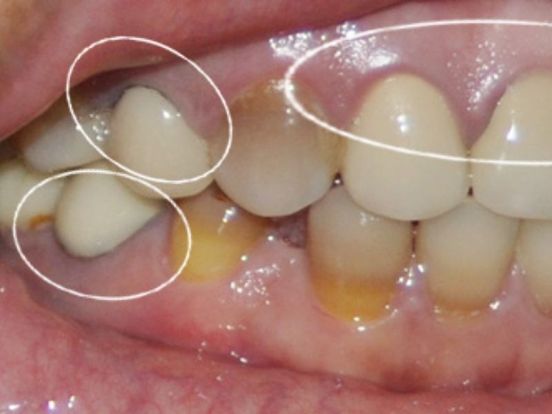 Biến chứng có thể gặp khi bọc răng sứ