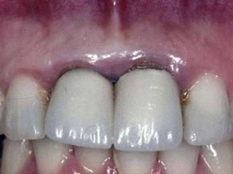 Biến chứng có thể gặp khi bọc răng sứ
