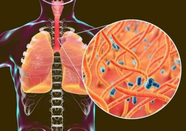 Bệnh ho gà gây ra bởi vi khuẩn Bordetella Pertussis