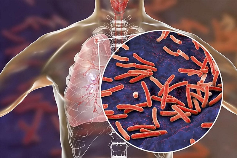 Trực khuẩn lao (Mycobacterium tuberculosis)