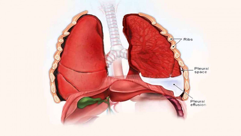 Khó thở, suy hô hấp cấp do tràn dịch màng phổi