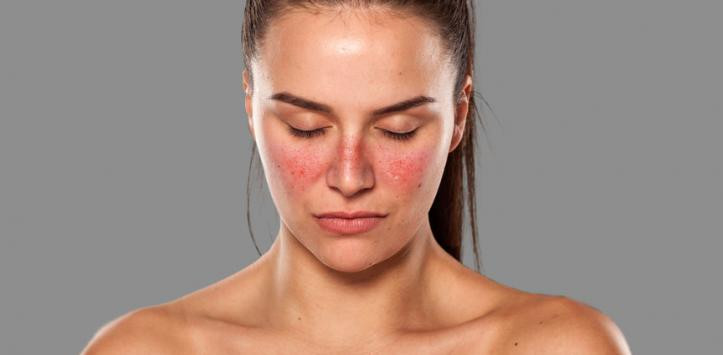 Nguyên nhân gây bệnh Lupus ban đỏ