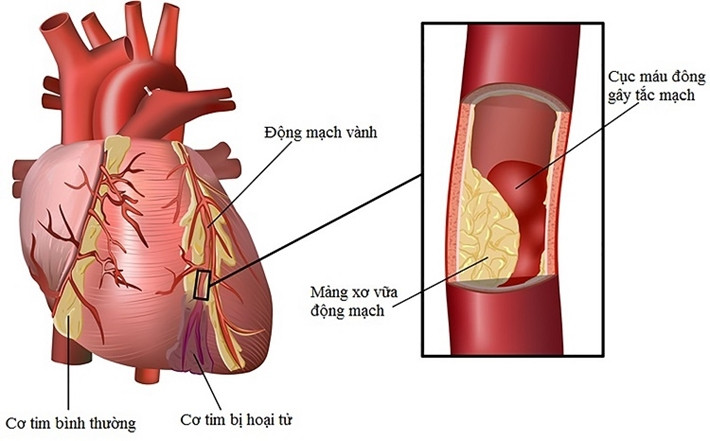 Bệnh mạch vành là gì?