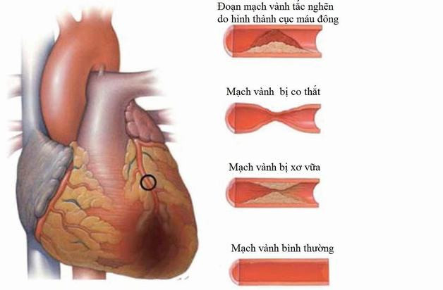 Bệnh mạch vành co thắt