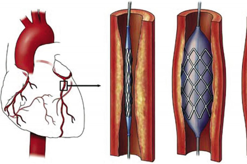 Đặt stent mạch vành