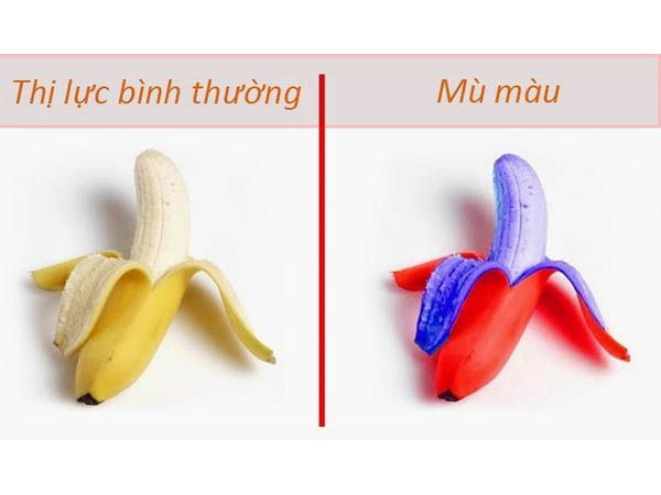 Bệnh mù màu là gì?