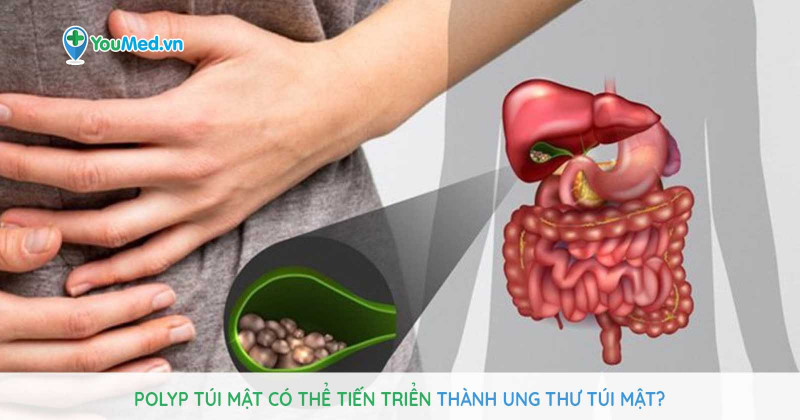 Polyp túi mật có thể tiến triển thành ung thư túi mật