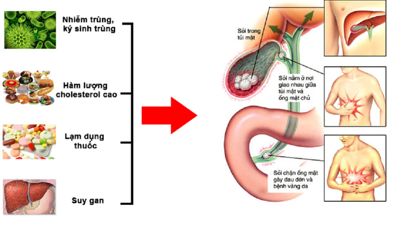 Nguyên nhân bệnh polyp túi mật