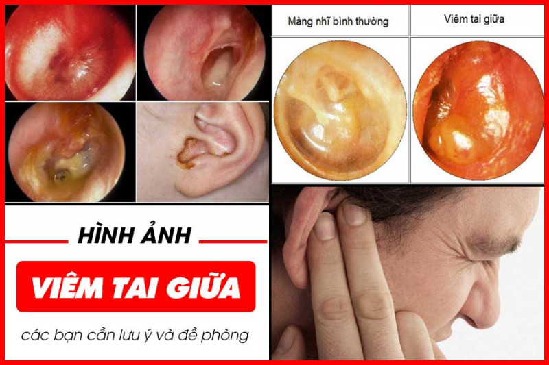 Hình ảnh viêm tai giữa