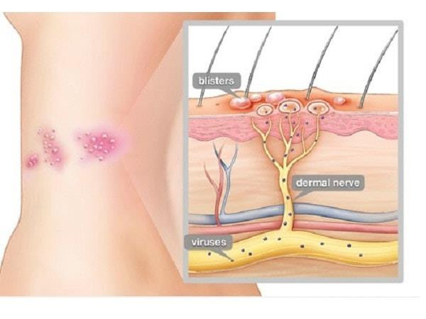 Bệnh Zona thần kinh