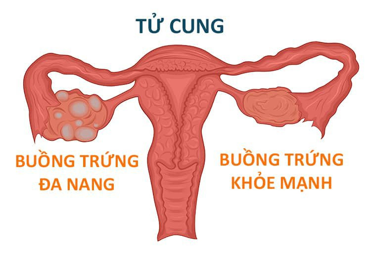 Hội chứng buồng trứng đa nang - một trong những nguyên nhân gây rối loạn kinh nguyệt