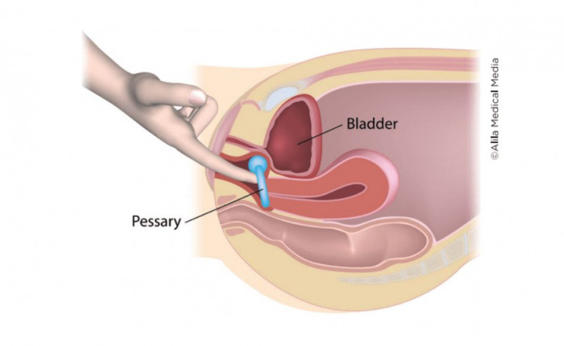 Sử dụng vòng nâng pessary