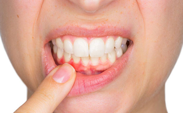 Sưng nướu chân răng là bệnh gì?