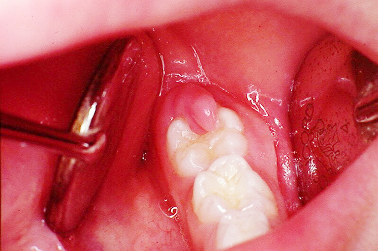 Mọc răng khôn - một trong những nguyên nhân gây sưng nướu chân răng