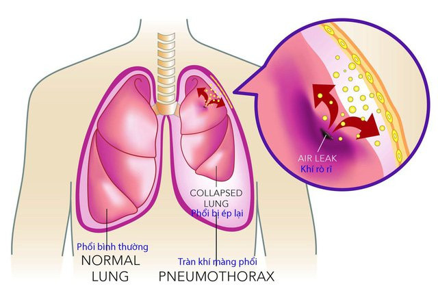 Tràn dịch màng phổi - một trong những nguyên nhân dẫn đến suy hô hấp