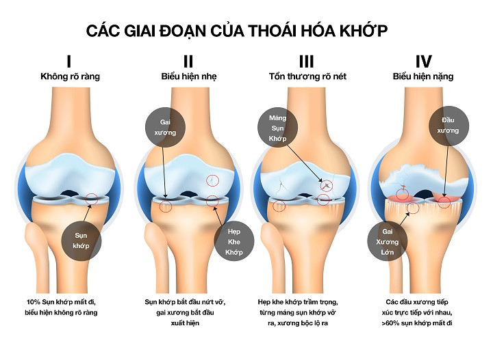 Các giai đoạn của thoái hóa khớp