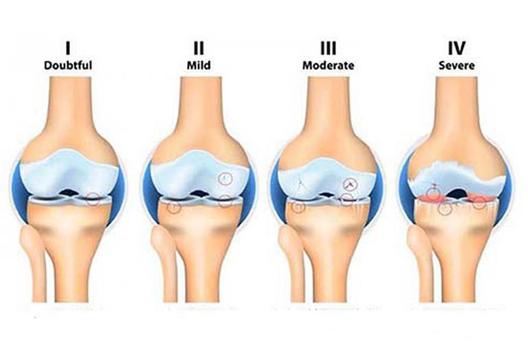 Các giai đoạn của viêm khớp dạng thấp