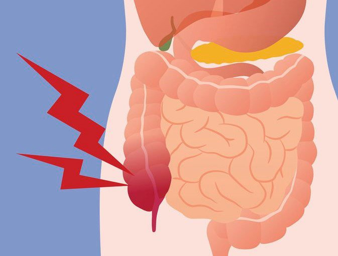 Áp xe ruột thừa - một trong những biến chứng của viêm ruột thừa