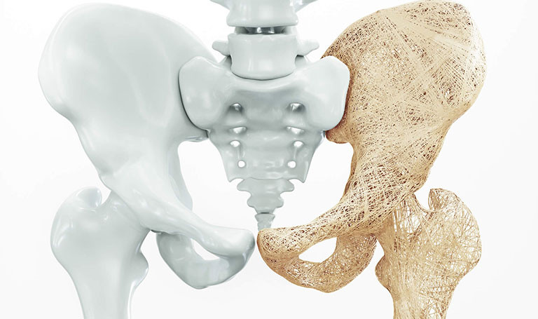 Bệnh loãng xương được chia thành nhiều cấp độ phát triển