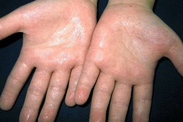 Mồ hôi tay cũng là nguyên nhân gây nấm ăn tay