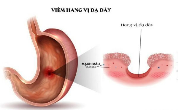 Viêm hang vị dạy dày là gì?