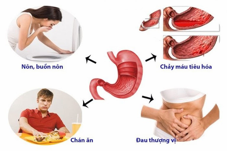 Chẩn đoán viêm hang vị dạ dày