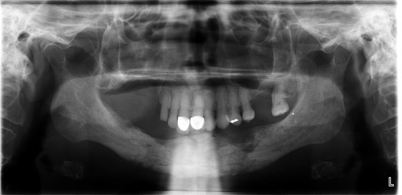 Hoại tử xương hàm - biến chứng có thể gặp sau khi nhổ răng