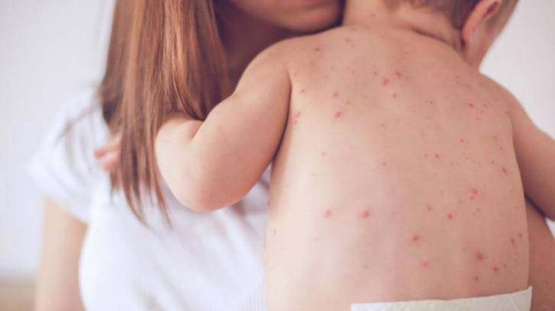 Cách phòng ngừa phát ban không sốt ở trẻ